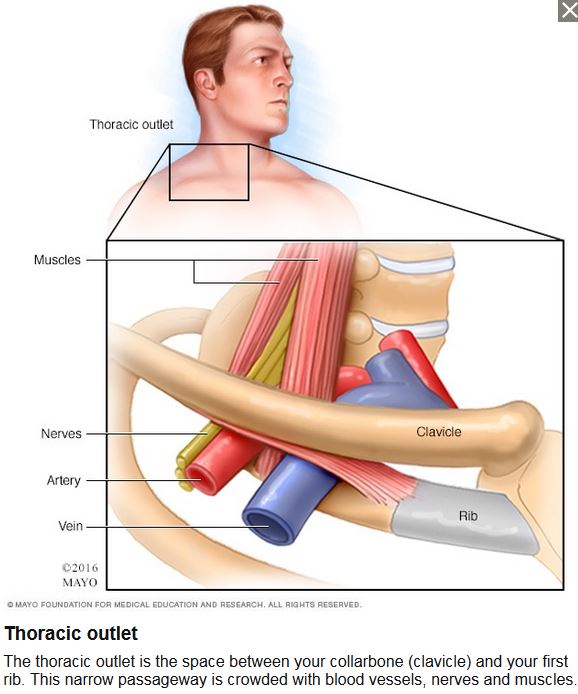 Help for Thoracic Outlet Syndrome - Yoga Can Help - Yoga Vista Academy